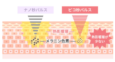 従来のレーザーとの熱影響層の比較 肌断面イラスト