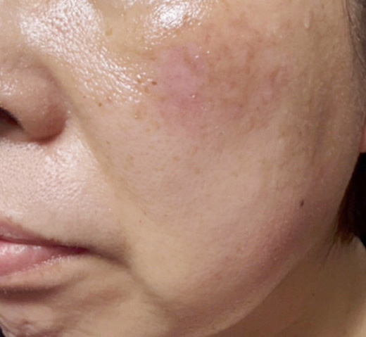 1週間後:痂皮はかなり脱落したが、まだ一部残存