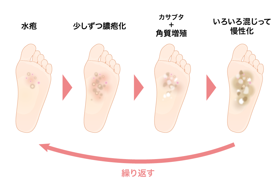 掌蹠膿疱症の症状