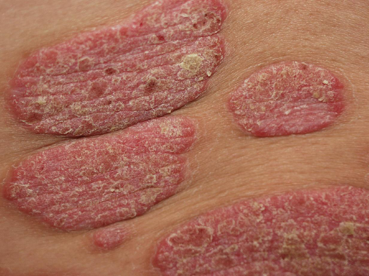 乾癬および乾癬性関節炎の典型的な発症年齢