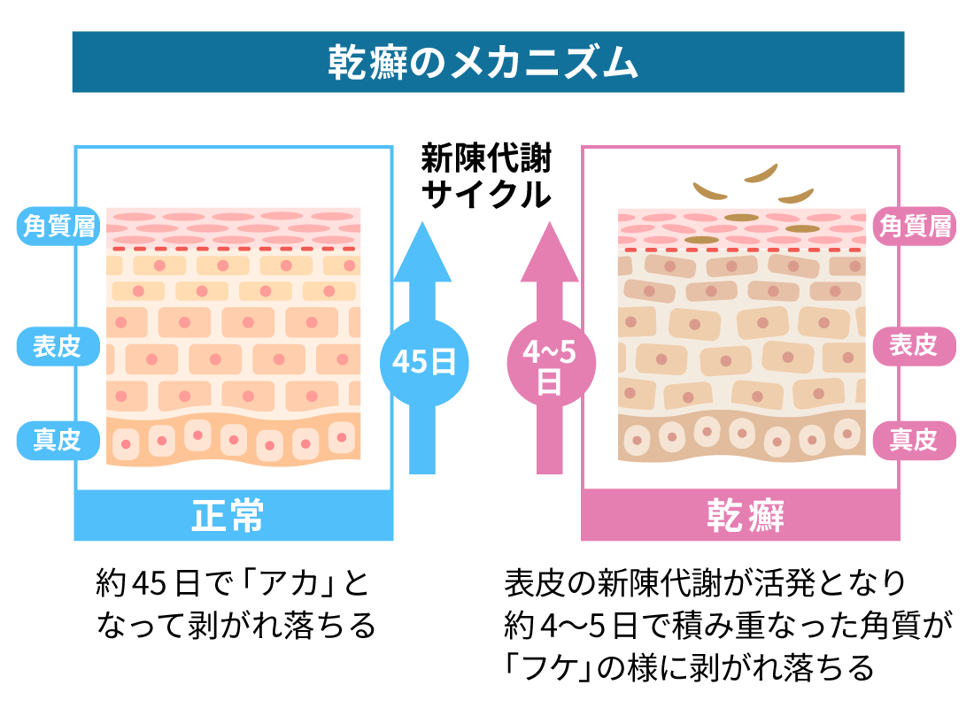 乾癬が手に移ることはありますか?