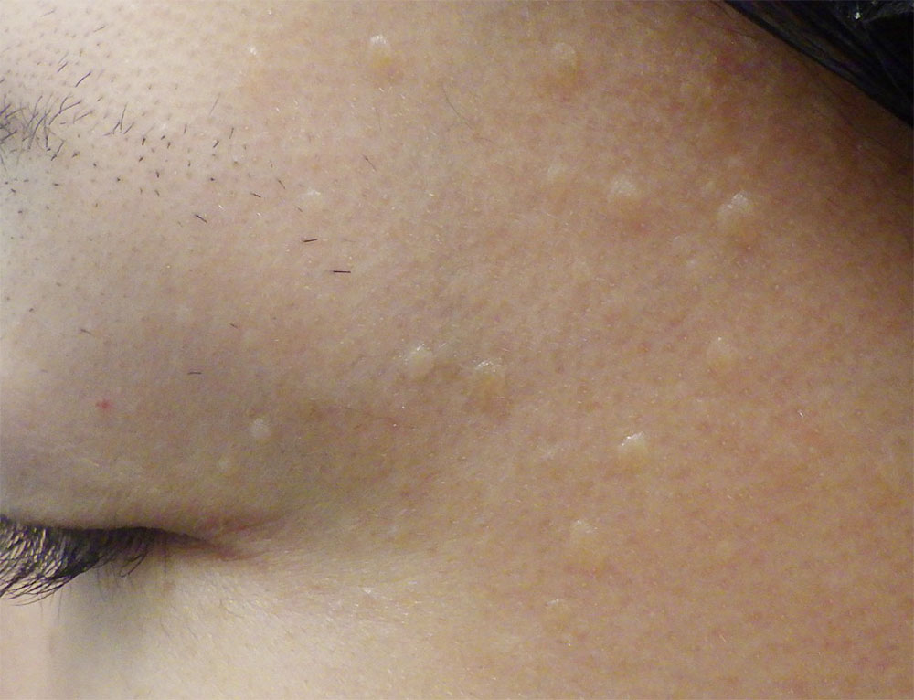 典型的な青年性扁平疣贅の例